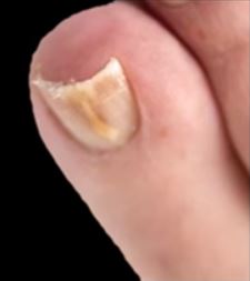 u-shaped toenail